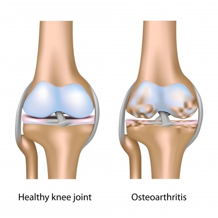 healthy knee joint vs knee with osteoarthritis