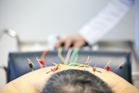 electro acupunture on upper back