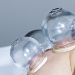 cupping with glass cups on a patient's shoulder