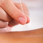 Acupuncture needle on skin
