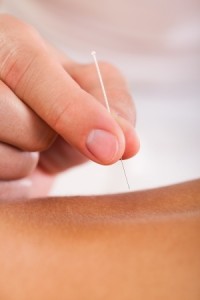 a hand performing dry needling on a patient