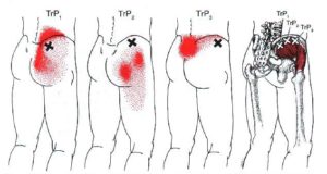 Trigger points glute medius