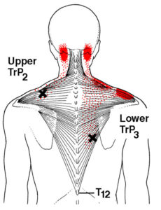 Trigger points trapezius