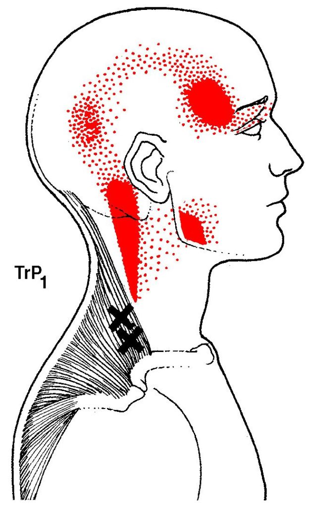 dry-needling-therapy-trigger-point-muscle-treatment-california