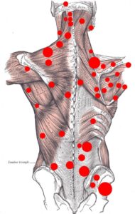 Trigger Point Map on Back and Neck with red dots showing areas with trigger points
